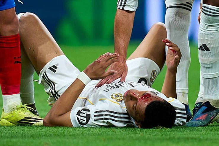 Mbappe bị thúc cùi chỏ chảy máu, Real Madrid kêu oan đòi phạt đền