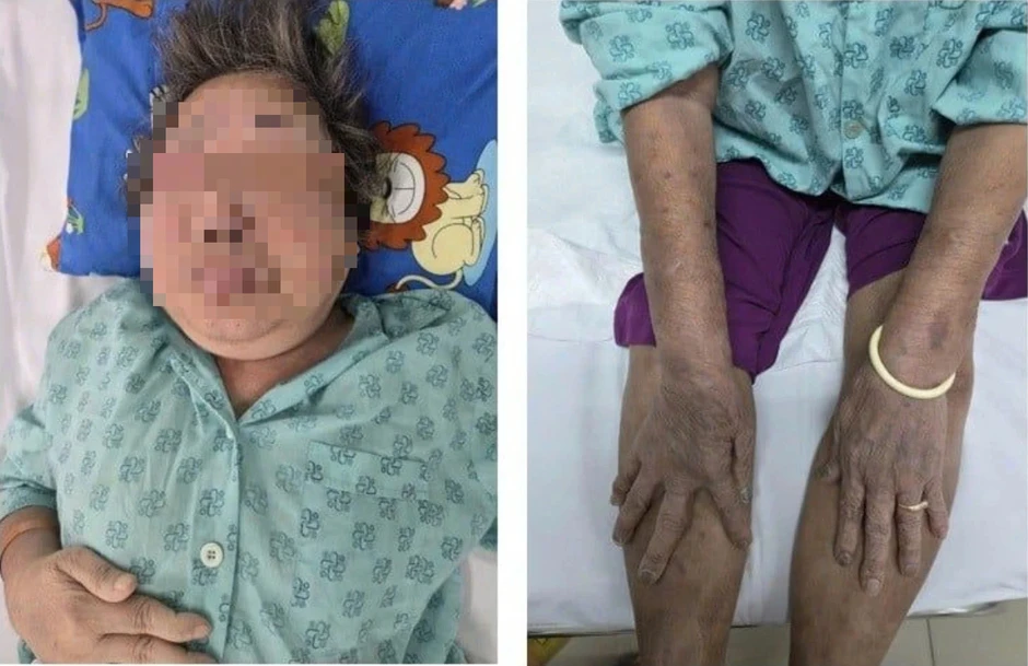 Tự uống thuốc giảm đau, cụ ông 87 tuổi nhập viện ở TP.HCM Tự uống thuốc giảm đau, cụ ông 87 tuổi nhập viện ở TP.HCM