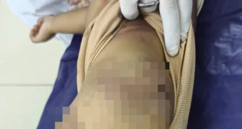 Vụ bé trai 2 tuổi bị mẹ ruột và cha dượng bạo hành: Người thân từ chối chăm sóc