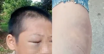 Xác minh clip bé trai mắt bầm tím, khóc kêu cứu vì 'nhiều lần bị đánh đập'