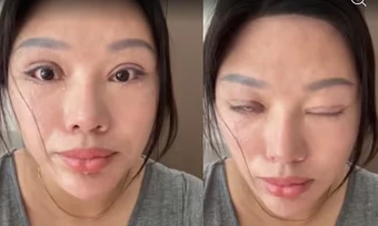 6 năm không thể nhắm kín mắt