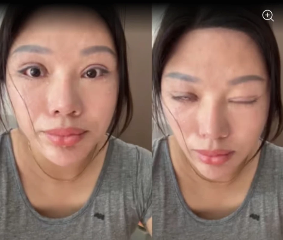 6 năm không thể nhắm mắt vì cắt mí 6 năm không thể nhắm mắt vì cắt mí