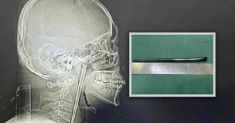 Ăn nhầm chiếc đũa 12cm, người đàn ông Trung Quốc chịu đựng trong 8 năm