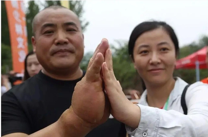 Bàn tay dày bất thường của võ sư mê truyện Kim Dung luyện võ hơn 20 năm Bàn tay dày bất thường của võ sư mê truyện Kim Dung luyện võ hơn 20 năm