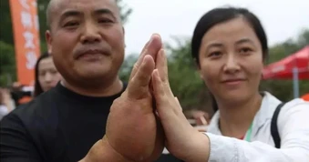 Bàn tay dày bất thường của võ sư mê truyện Kim Dung luyện võ hơn 20 năm