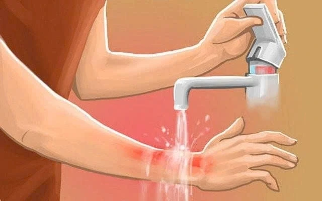 Bị bỏng nước sôi phải làm gì? Hướng dẫn xử trí và phòng tránh Bị bỏng nước sôi phải làm gì? Hướng dẫn xử trí và phòng tránh