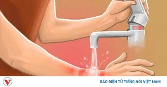 Bị bỏng nước sôi phải làm gì? Hướng dẫn xử trí và phòng tránh