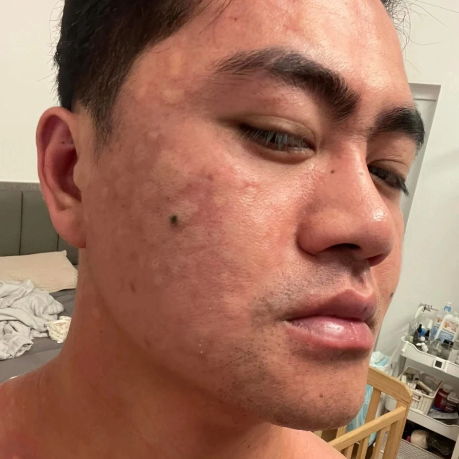 Chàng trai Hà Nội sưng mắt, khó thở vì món đặc sản "khổ trước, sướng sau" Chàng trai Hà Nội sưng mắt, khó thở vì món đặc sản "khổ trước, sướng sau"