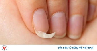 Móng tay giòn, dễ gãy là biểu hiện của những vấn đề sức khỏe không thể bỏ qua