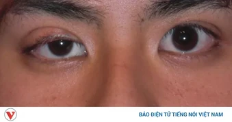 Nhiều người tự ti vì mắt lệch mí, đâu là cách khắc phục phù hợp?
