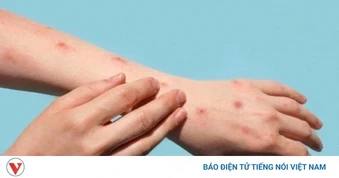 Thủy đậu tăng nhanh khi giao mùa: Làm gì để phòng bệnh hiệu quả?