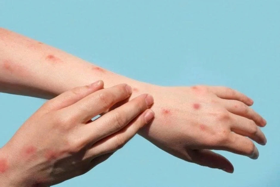 Thủy đậu tăng nhanh khi giao mùa: Làm gì để phòng bệnh hiệu quả? Thủy đậu tăng nhanh khi giao mùa: Làm gì để phòng bệnh hiệu quả?