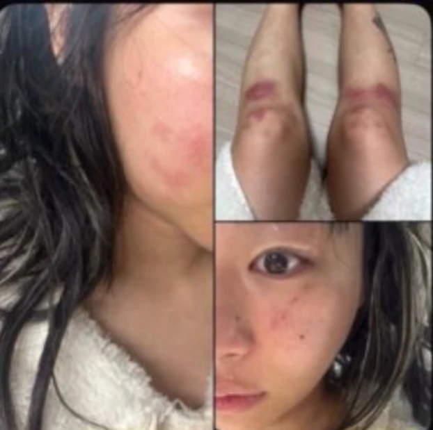 Nữ ca sĩ yêu lại bạn trai cũ từng đánh cô bầm dập toàn thân: “Tôi không kiện anh ấy nữa” Nữ ca sĩ yêu lại bạn trai cũ từng đánh cô bầm dập toàn thân: “Tôi không kiện anh ấy nữa”