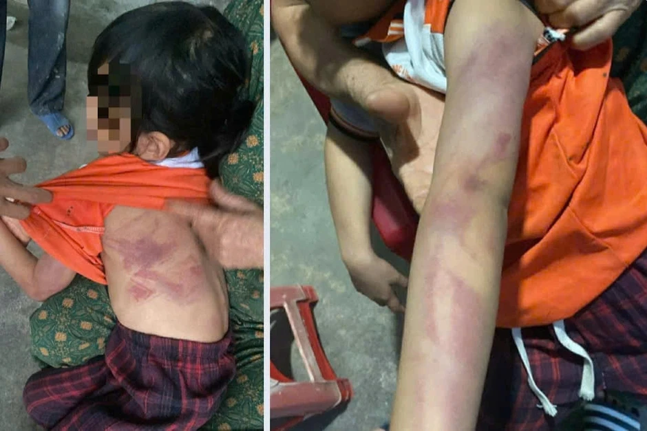 Bé gái lớp 2 bị bạn đánh bầm tím da vì lời hứa "cho kẹo" Bé gái lớp 2 bị bạn đánh bầm tím da vì lời hứa "cho kẹo"