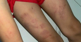 Bé trai có nhiều vết bầm sau khi gửi trẻ, 3 tháng chưa được làm rõ