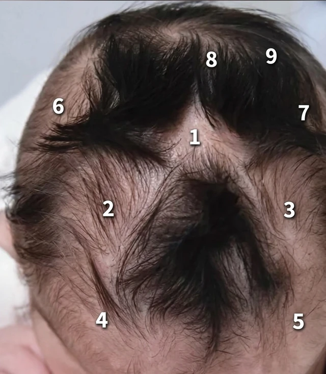 Em bé gây chú ý vì có tới 9 xoáy tóc trên đầu: Liệu có điều gì đặc biệt liên quan đến não bộ của bé?