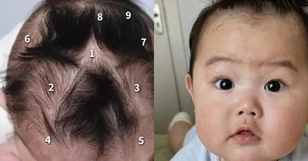 Em bé gây chú ý vì có tới 9 xoáy tóc trên đầu: Liệu có điều gì đặc biệt liên quan đến não bộ của bé?