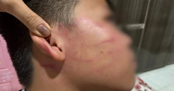 Nam sinh 9 tuổi nghi bị giáo viên dạy thêm đánh bầm mặt, ù tai