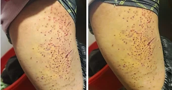 Tranh chấp chỗ ngồi, nữ sinh lớp 7 dùng bút bi đâm nhiều lần vào đùi bạn học