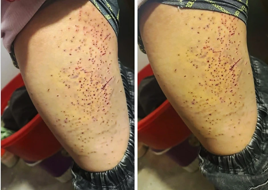 Tranh chấp chỗ ngồi, nữ sinh lớp 7 dùng bút bi đâm nhiều lần vào đùi bạn học Tranh chấp chỗ ngồi, nữ sinh lớp 7 dùng bút bi đâm nhiều lần vào đùi bạn học