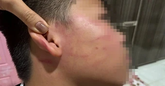 Xác minh thông tin giáo viên dạy thêm đánh học sinh lớp 4 bầm tím vùng mặt