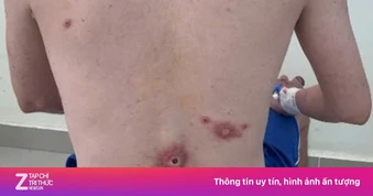 Bệnh đường tình dục tăng, đường lây truyền ngày càng phức tạp