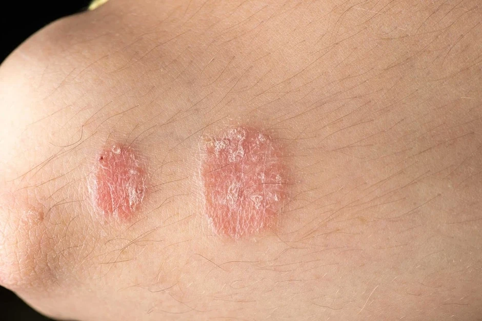 Cảnh giác với 4 biểu hiện lạ trên da có thể là dấu hiệu HIV Cảnh giác với 4 biểu hiện lạ trên da có thể là dấu hiệu HIV
