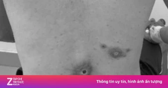 Hai bệnh lây qua tình dục tăng mạnh ở nam giới tại TP.HCM