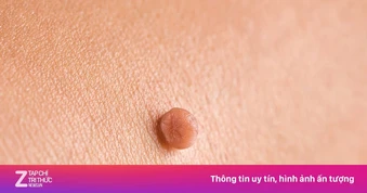 Mắc sùi mào gà ở tuổi 20