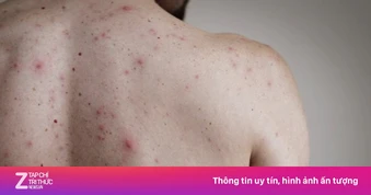 Nam thanh niên phát hiện mắc giang mai từ dấu hiệu lạ