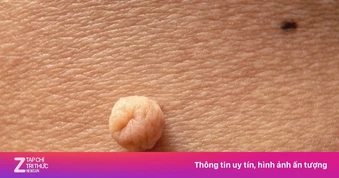 Sai lầm khiến người đàn ông có đến 103 nốt sùi mào gà