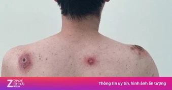 Thay đổi đáng báo động về bệnh lây qua tình dục tại TP.HCM