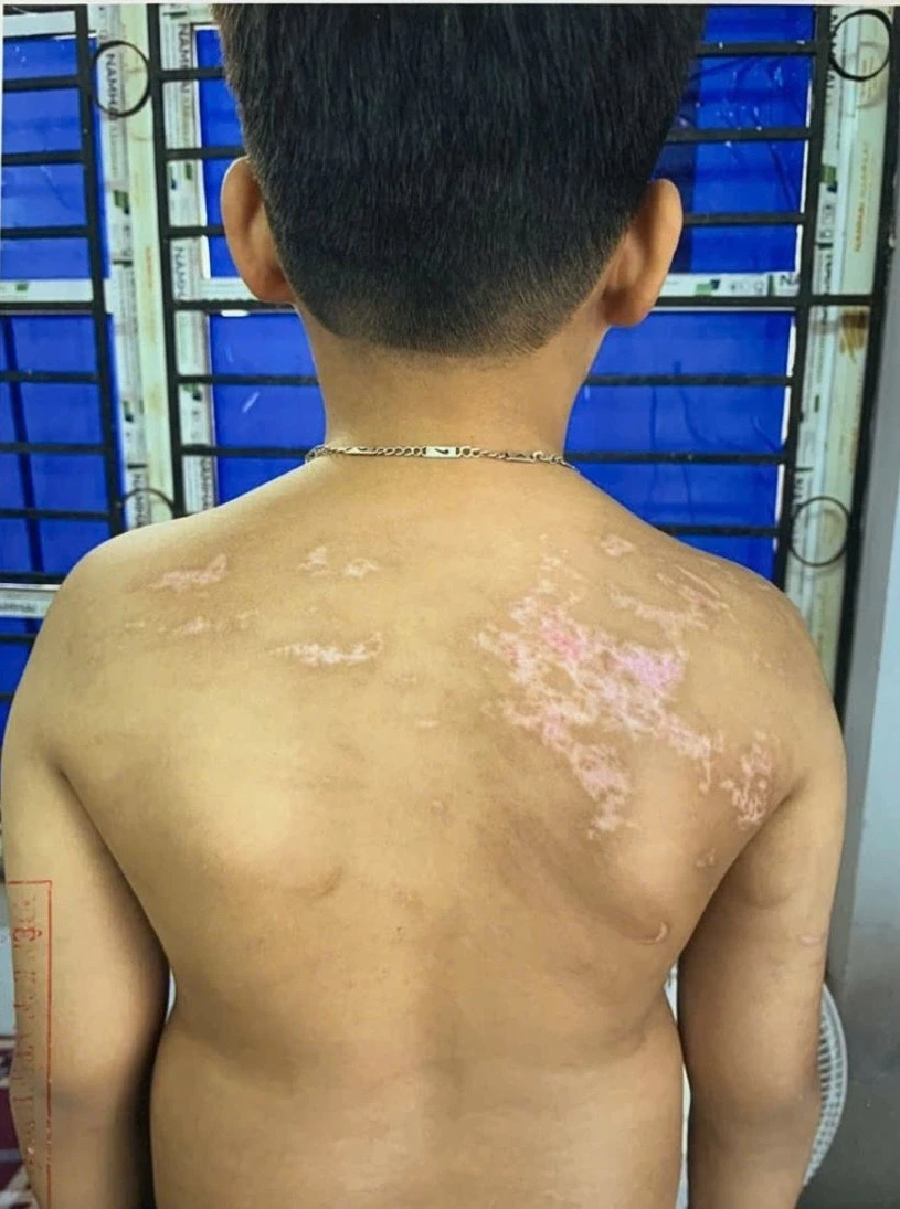 Khởi tố ông bố bạo hành con ruột gây thương tích 36% Khởi tố ông bố bạo hành con ruột gây thương tích 36%