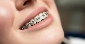 Bí ẩn tiến hóa đằng sau việc ngày càng nhiều người phải niềng răng