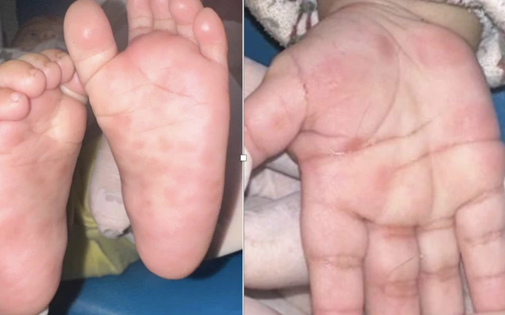 Nghiên cứu từ Việt Nam cho thấy bệnh giang mai có thể đã xuất hiện hàng ngàn năm trước Nghiên cứu từ Việt Nam cho thấy bệnh giang mai có thể đã xuất hiện hàng ngàn năm trước