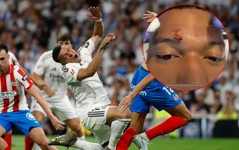 Mbappe phải khâu lông mày trước thềm đại chiến Bayern