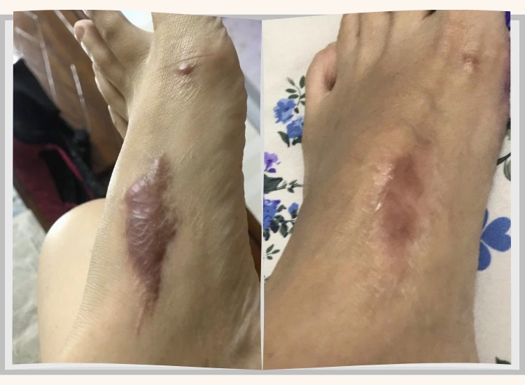 30 - 50% nguy cơ sẹo lồi xuất phát từ một yếu tố ít được nhắc đến 30 - 50% nguy cơ sẹo lồi xuất phát từ một yếu tố ít được nhắc đến