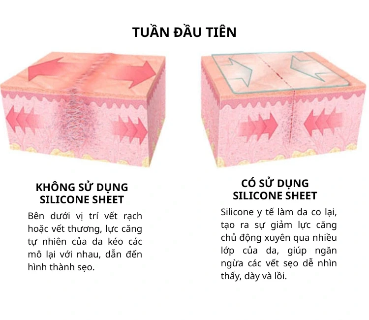 30 - 50% nguy cơ sẹo lồi xuất phát từ một yếu tố ít được nhắc đến 30 - 50% nguy cơ sẹo lồi xuất phát từ một yếu tố ít được nhắc đến