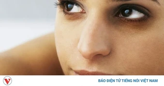 5 cách đơn giản giúp giảm quầng thâm mắt ngay tại nhà