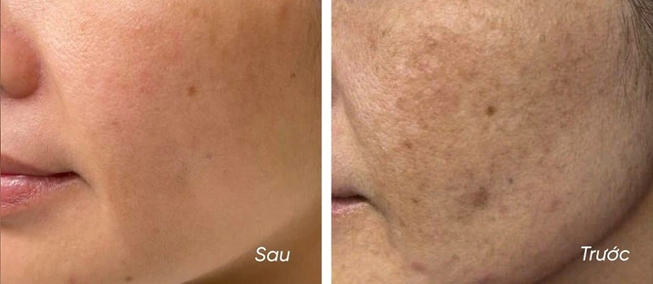 5 kem giúp mờ nám, da trắng sáng sau khoảng 4 tuần, kể cả nám hỗn hợp 5 kem giúp mờ nám, da trắng sáng sau khoảng 4 tuần, kể cả nám hỗn hợp