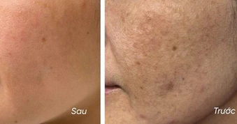 5 kem giúp mờ nám, da trắng sáng sau khoảng 4 tuần, kể cả nám hỗn hợp