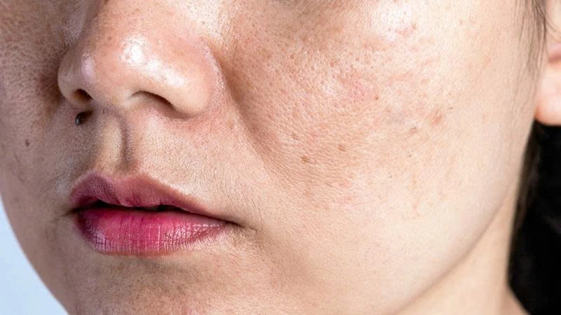 5 sai lầm mỗi ngày khiến da dễ nám hơn, nhiều chị em vẫn vô tình mắc 5 sai lầm mỗi ngày khiến da dễ nám hơn, nhiều chị em vẫn vô tình mắc