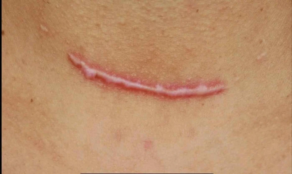 Áp lực cơ học và tăng sinh collagen: Góc nhìn mới trong phòng ngừa sẹo hậu phẫu Áp lực cơ học và tăng sinh collagen: Góc nhìn mới trong phòng ngừa sẹo hậu phẫu