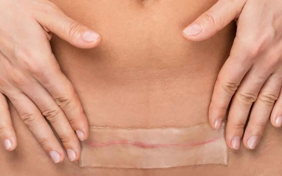 Áp lực cơ học và tăng sinh collagen: Góc nhìn mới trong phòng ngừa sẹo hậu phẫu Áp lực cơ học và tăng sinh collagen: Góc nhìn mới trong phòng ngừa sẹo hậu phẫu