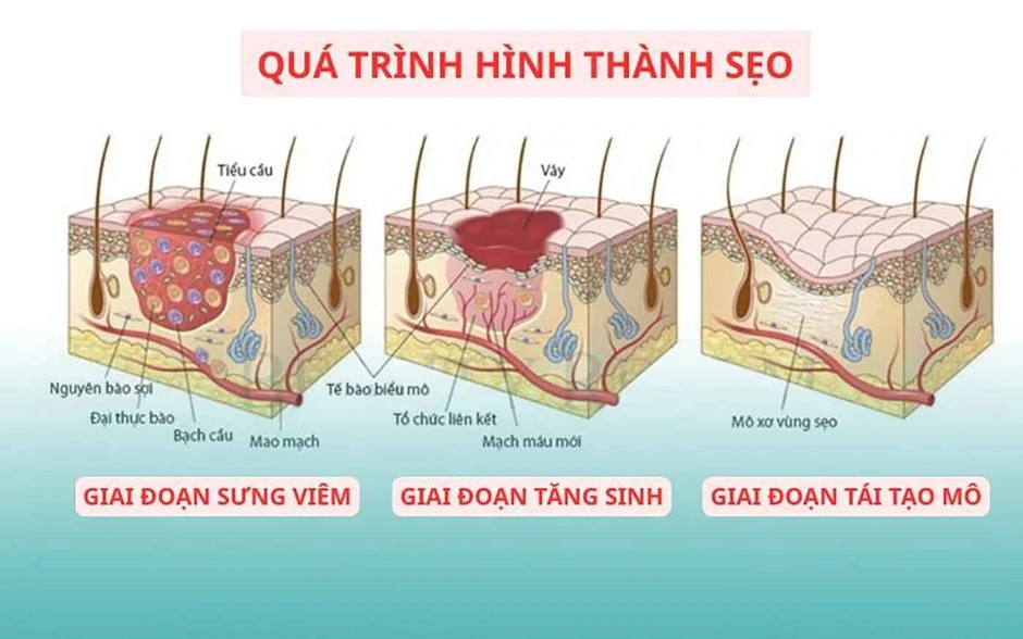 Áp lực cơ học và tăng sinh collagen: Góc nhìn mới trong phòng ngừa sẹo hậu phẫu Áp lực cơ học và tăng sinh collagen: Góc nhìn mới trong phòng ngừa sẹo hậu phẫu