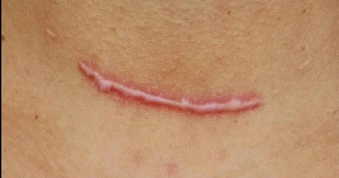Áp lực cơ học và tăng sinh collagen: Góc nhìn mới trong phòng ngừa sẹo hậu phẫu