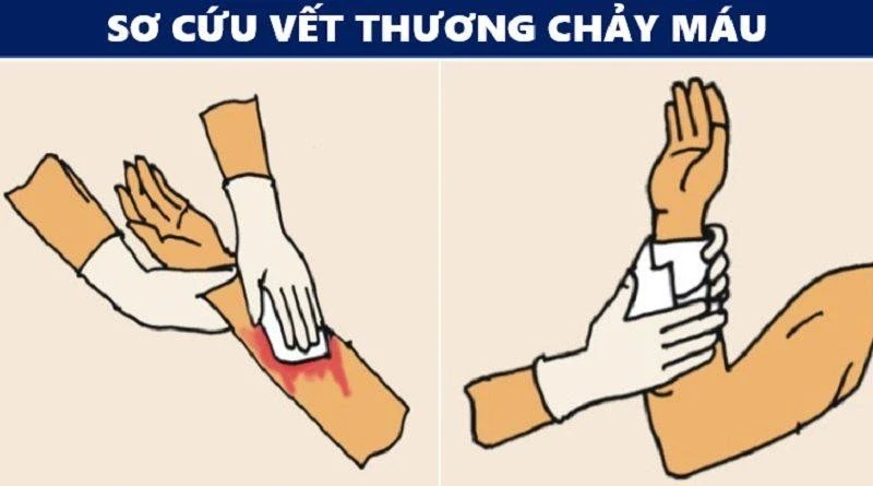 Bật mí cách xử lý vết thương chuẩn y khoa mà nhiều người thực hiện sai