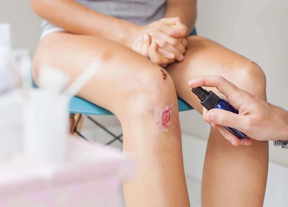 Cách giúp vết thương hở nhanh lành chuẩn y khoa ngăn ngừa nhiễm trùng và sẹo xấu Cách giúp vết thương hở nhanh lành chuẩn y khoa ngăn ngừa nhiễm trùng và sẹo xấu