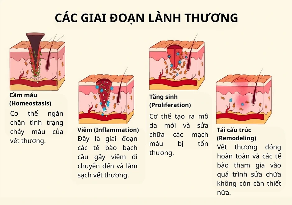 Cách mờ sẹo mụn sau laser: Giảm viêm, hỗ trợ lành thương và tái tạo thể tích Cách mờ sẹo mụn sau laser: Giảm viêm, hỗ trợ lành thương và tái tạo thể tích