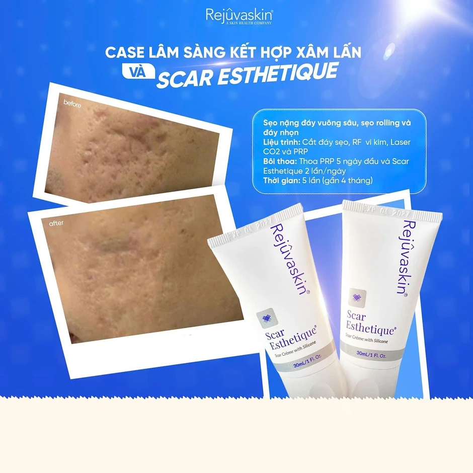 Cách mờ sẹo mụn sau laser: Giảm viêm, hỗ trợ lành thương và tái tạo thể tích Cách mờ sẹo mụn sau laser: Giảm viêm, hỗ trợ lành thương và tái tạo thể tích